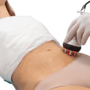 Bono de radiofrecuencia facial